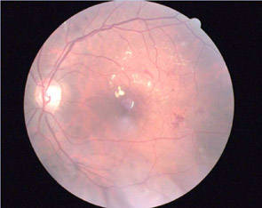 Diabetic Retinopathy with haemorrhage and exudate